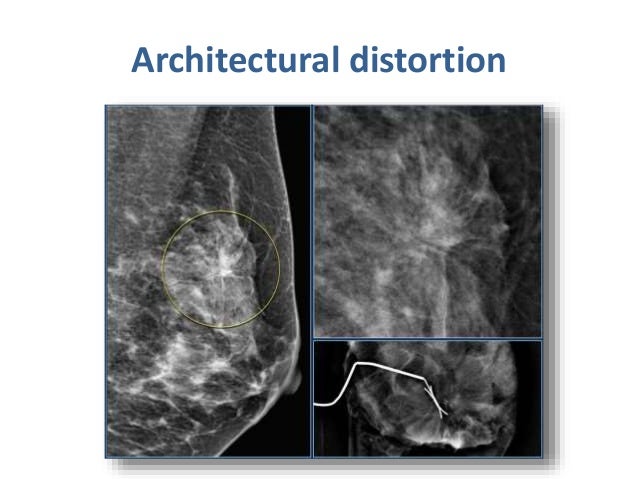 architectural breast distortion Dr phil troubled teen love